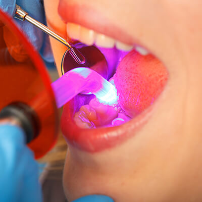 The dentist performing a laser surgery on a tooth